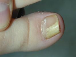 Herbs, plants from nail fungus